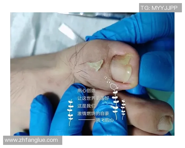 足球明星因甲沟炎困扰赛季表现专家解析病因与康复之道